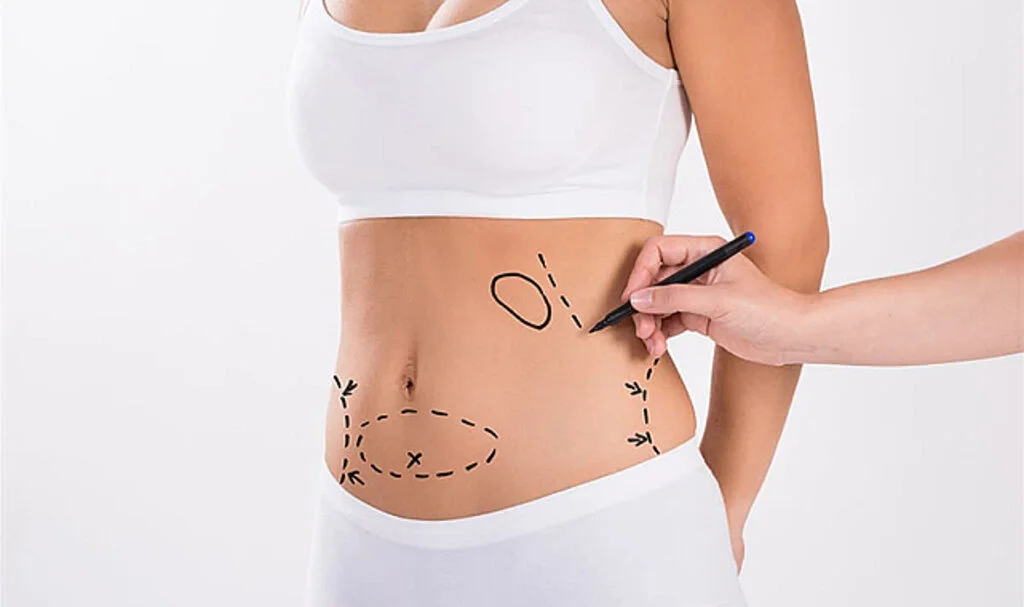 Liposuction nedir, kimler yaptırabilir, nasıl uygulanır?