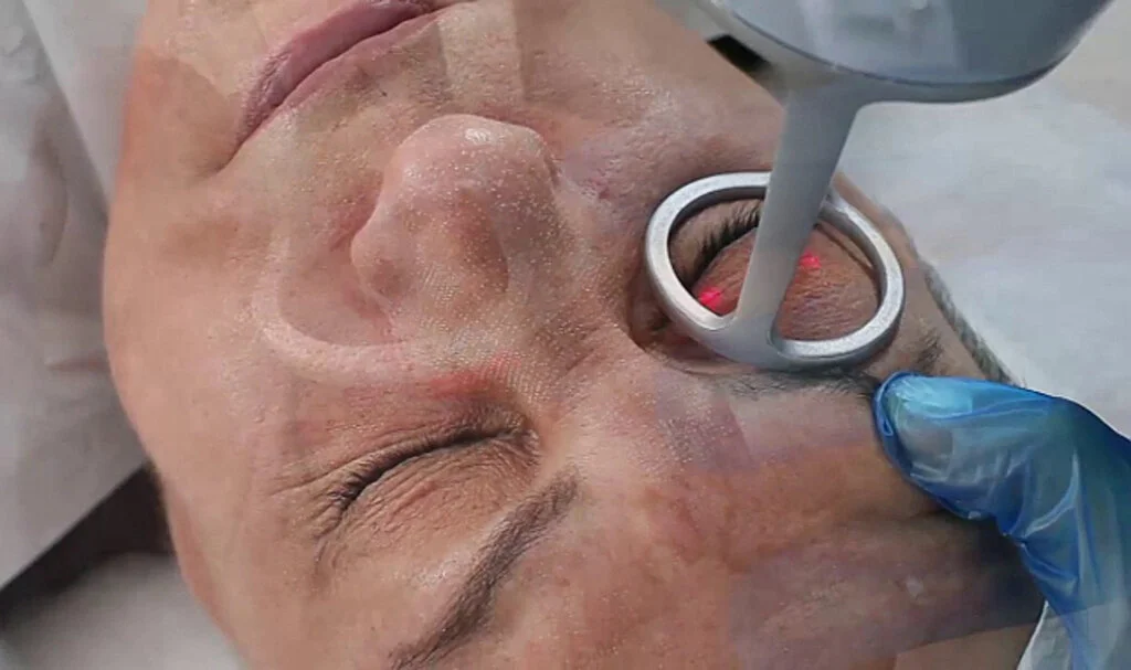 Thulium Lazer nedir?