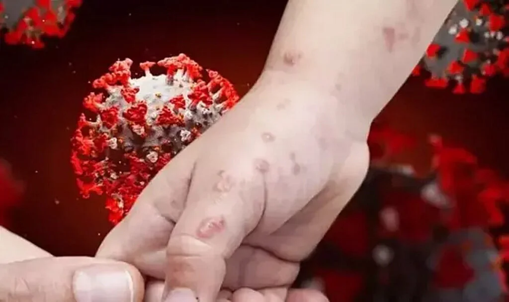 Maymun Çiçeği Virüsü Alarmı: Türkiye'de Önlemler Alındı