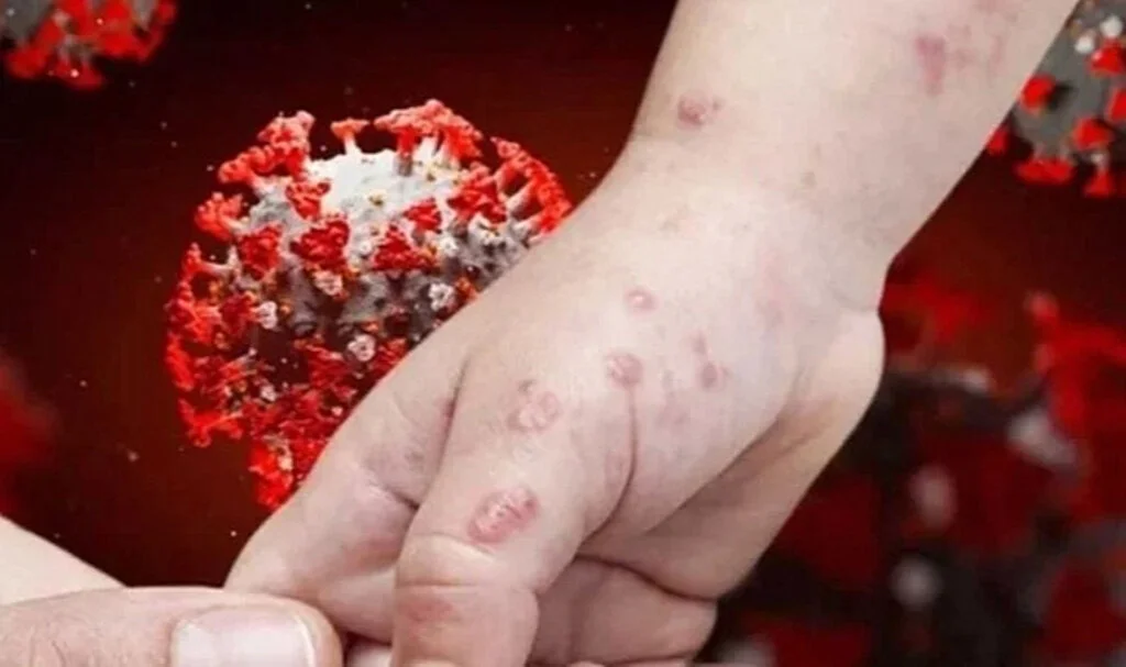 Mpox Salgını Pakistan'da: BAE'den Gelen Yolcularda Tespit Edildi