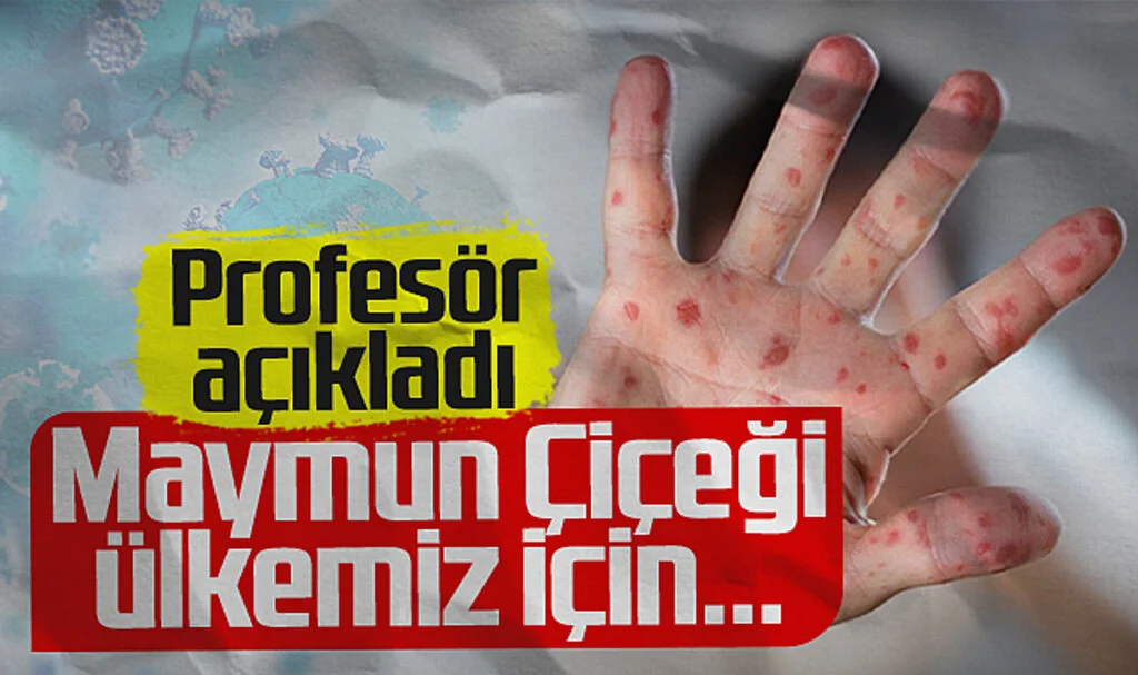Profesör Açıkladı! Maymun Çiçeği Virüsü Türkiye İçin...