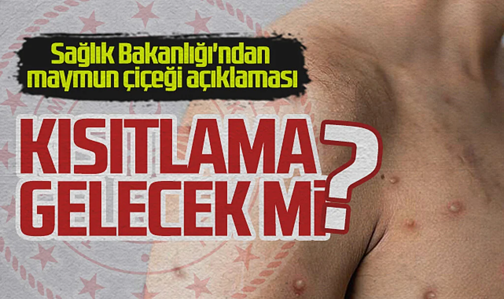 Sağlık Bakanlığı'ndan maymun çiçeği açıklaması: Vaka var mı, kısıtlama gelecek mi?