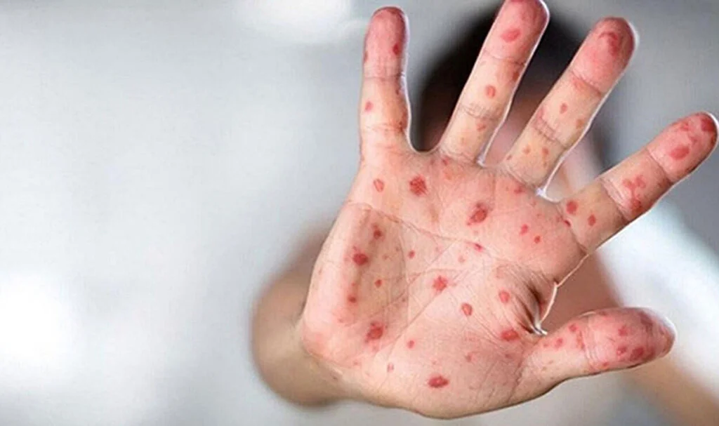 Türkiye'de İlk Maymun Çiçeği Karantinası: Şüpheli Vakalara Test Yapıldı