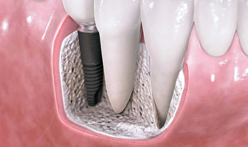 all-on-6-implant-in-antalya