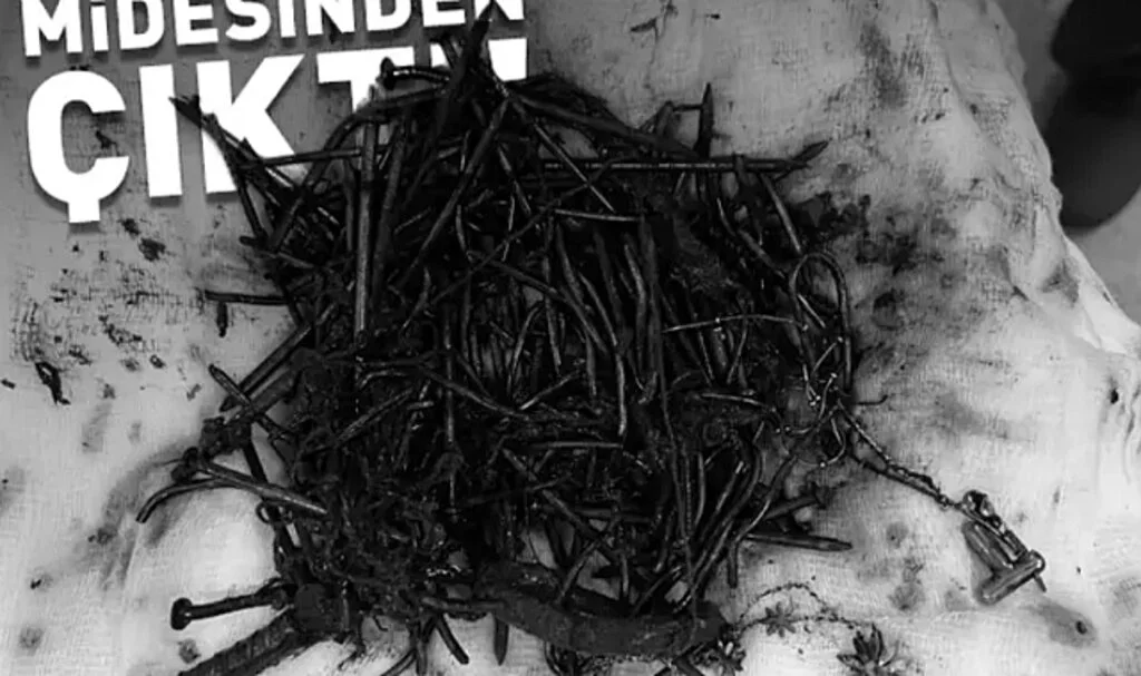 Zihinsel engelli kadın hastanın midesinden 1 kilo metal cisim çıktı
