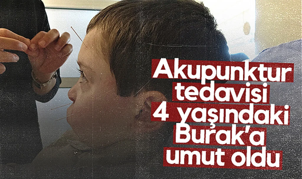 Akupunktur Tedavisi 4 Yaşındaki Burak’a Umut Oldu
