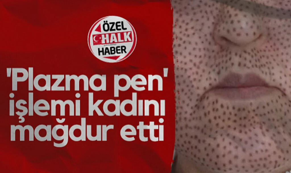 Samsun'da 'Plazma Pen' İşlemi Kadını Mağdur Etti
