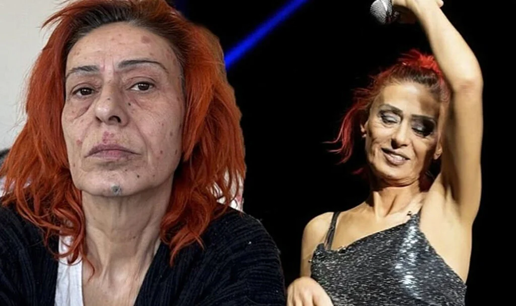 Yıldız Tilbe Yüzündeki Yanıklarla İlk Kez Göründü