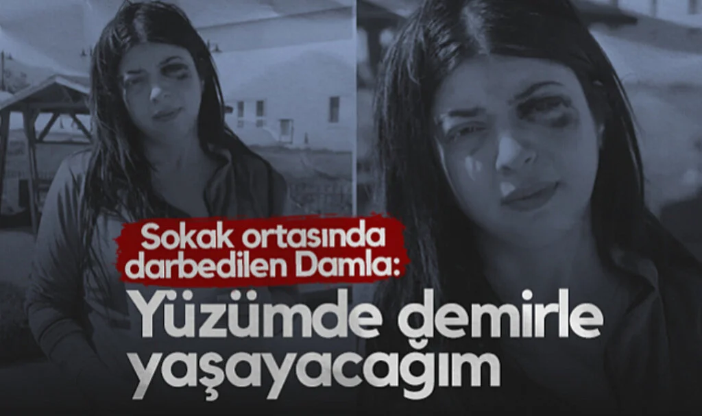 Samsun'da Sokak Ortasında Darbedilen Damla: Yüzümde Demirle Yaşayacağım