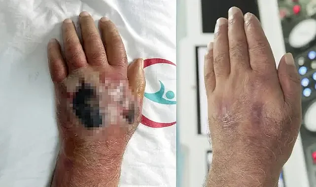 Bu Bir İnsan Isırığı! 60 Yaşındaki Esnafın Kolu Son Anda Kurtarıldı