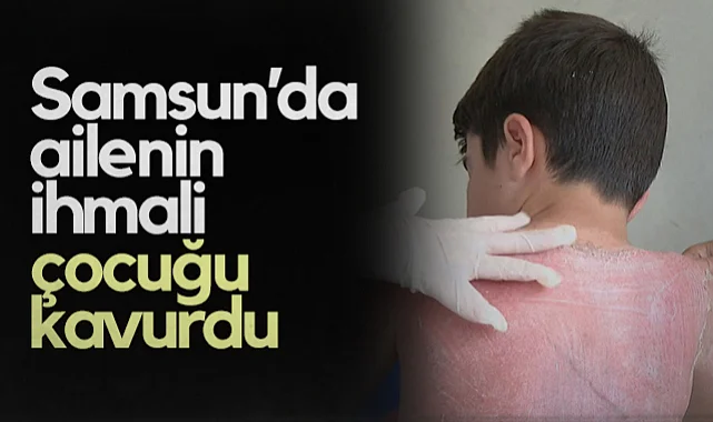 Samsun'da 7 Yaşındaki Çocuk Güneş Yanığıyla Hastaneye Kaldırıldı