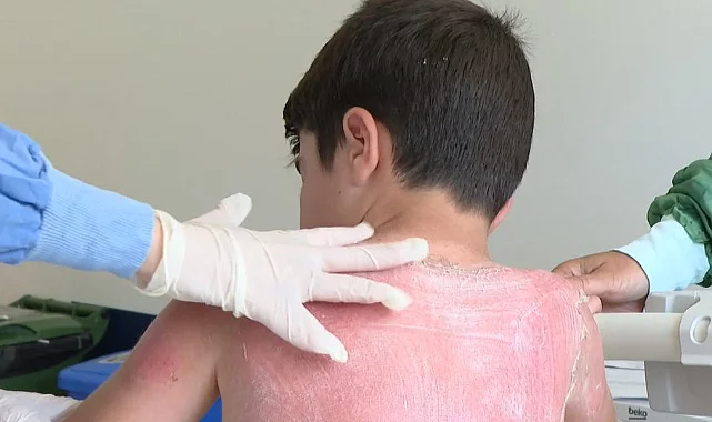 Samsun'da Tatili Kabusa Dönüştü: Çocuk İki derece Yanıkla Hastanelik Oldu
