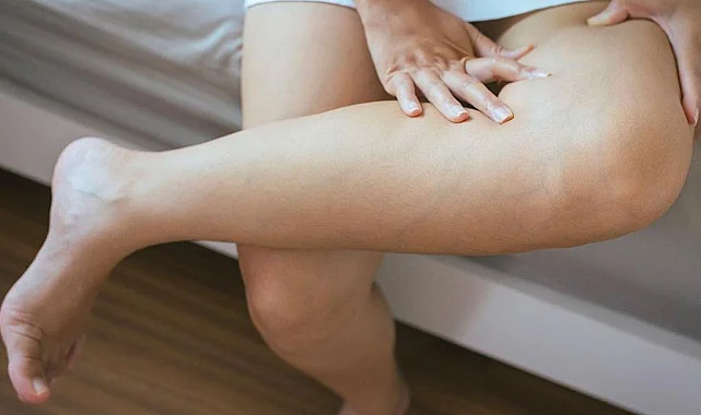 Lenfödem Nedir? Belirtileri ve Tedavi Yöntemleri