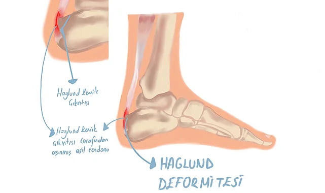 Haglund Deformitesi: Topukta Kemik Çıkıntısı Neden Olur, Nasıl Geçer?