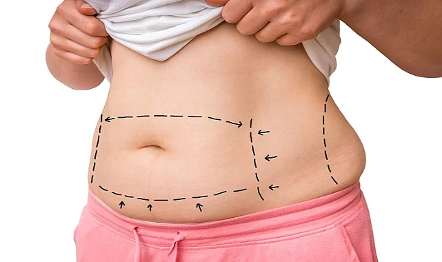 Liposuction ile Tüm İnatçı Yağlarınıza Veda Edin