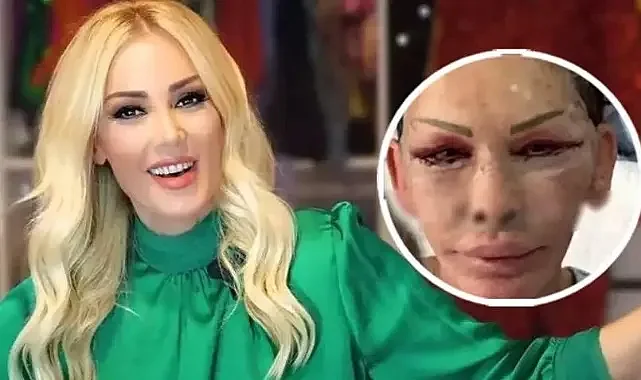 Petek Dinççöz'ün Makyajsız Hali Göz Doldurdu: Estetik Sonrası Görünen Değişim