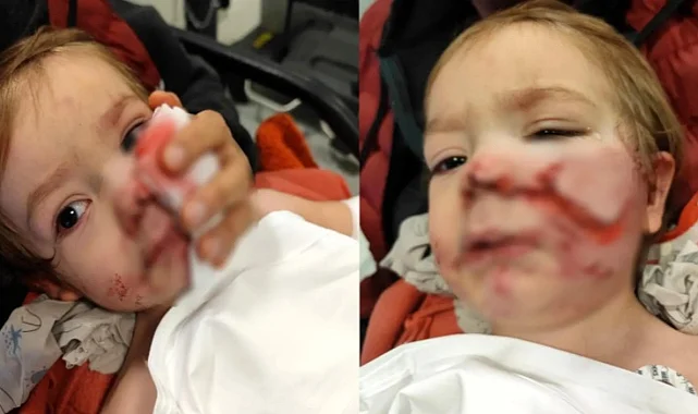 Pitbull Saldırısına Uğrayan Minik Efe'den Yeni Haber: Yüzünde İz Kalma Riski Var, Enfeksiyon Endişesi Sürüyor