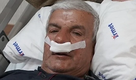 Yıllarca Nefes Alamıyordu, Burnundan Tam 100 Gram Taş Çıktı
