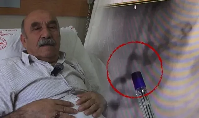 Göğüs Yanması Sandı Kalbinden Kan Çalan Damar Çıktı