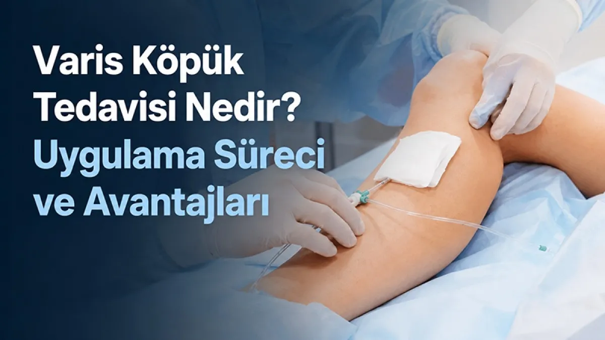 Varis Köpük Tedavisi Nedir? Uygulama Süreci ve Avantajları
