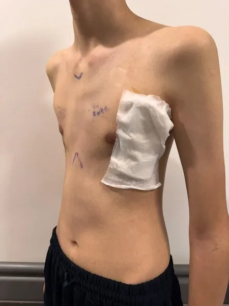 Samsun Şehir Hastanesi'nde bir ilk! 17 yaşındaki gence kapalı ameliyat